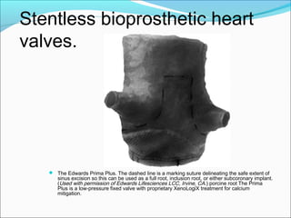 Stentless bioprosthetic heart
valves.
 The Edwards Prima Plus. The dashed line is a marking suture delineating the safe extent of
sinus excision so this can be used as a full root, inclusion root, or either subcoronary implant.
(Used with permission of Edwards Lifesciences LCC, Irvine, CA.) porcine root The Prima
Plus is a low-pressure fixed valve with proprietary XenoLogiX treatment for calcium
mitigation.
 