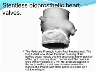 Stentless bioprosthetic heart
valves.
The Medtronic Freestyle Aortic Root Bioprosthesis. The
longitudinal view shows the fabric covering of the
porcine septal muscle and the associated higher position
of the right coronary stump. porcine root The device is
fixed with physiologic (40 mm Hg) pressure applied to
the aortic wall but a net zero pressure across the
leaflets. It is treated with alpha-amino-oleic acid as a
calcium mitigant.
 