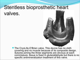 Stentless bioprosthetic heart
valves.
The CryoLife-O’Brien valve. This device has no cloth
covering and no muscle because of its composite design.
Sutures joining the three segments are obvious at each
commissure. tissue is fixed in glutaraldehyde but there is no
specific antimineralization treatment of this valve.
 