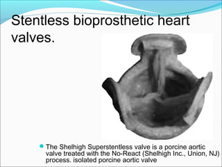 Stentless bioprosthetic heart
valves.
The Shelhigh Superstentless valve is a porcine aortic
valve treated with the No-React (Shelhigh Inc., Union, NJ)
process. isolated porcine aortic valve
 