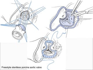 Freestyle stentless porcine aortic valve
Freestyle stentless porcine aortic valve
 