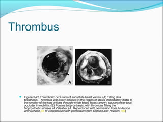 Thrombus
 Figure 5-25 Thrombotic occlusion of substitute heart valves. (A) Tilting disk
prosthesis. Thrombus was likely initiated in the region of stasis immediately distal to
the smaller of the two orifices through which blood flows (arrow), causing near-total
occluder immobility. (B) Porcine bioprosthesis, with thrombus filling the
bioprosthetic sinuses of Valsalva. (A: Reproduced with permission from Anderson
and Schoen.54 B: Reproduced with permission from Schoen and Hobson.199)
 