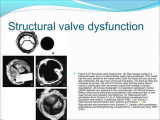 Structural valve dysfunction
 Figure 5-27 Structural valve dysfunction. (A) Disk escape owing to a
fractured lesser strut of a Bjork-Shiley heart valve prosthesis. This model
had the strut welded to the metal frame. Both the fractured strut and the
disk embolized; the strut was not found at autopsy. The fracture sites are
indicated by arrows. (B) and (C) Porcine valve primary tissue failure
owing to calcification with secondary cuspal tear leading to severe
regurgitation. (B) Gross photograph; (C) specimen radiograph. Dense
calcific deposits are apparent in the commissures. (D) Clinical Ionescu-
Shiley mitral bovine pericardial bioprosthesis with extensive tear of one
cusp (arrow) and resultant incompetence. (A: Reproduced with
permission from Schoen FJ, et al: Pathological considerations in
substitute heart valves. Cardiovasc Pathol 1992; 1:29. B and C:
Reproduced with permission from Schoen and Hobson.199 D:
Reproduced with permission from Schoen FJ: Cardiac valve prostheses:
pathological and bioengineering considerations. J Cardiovasc Surg 1987;
2:65.)
 
