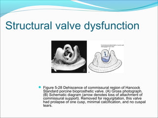 Structural valve dysfunction
 Figure 5-28 Dehiscence of commissural region of Hancock
Standard porcine bioprosthetic valve. (A) Gross photograph.
(B) Schematic diagram (arrow denotes loss of attachment of
commissural support). Removed for regurgitation, this valve
had prolapse of one cusp, minimal calcification, and no cuspal
tears.
 