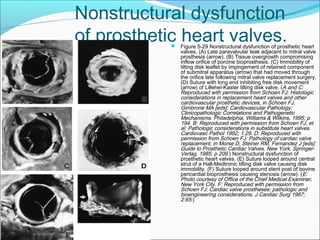 Nonstructural dysfunction
of prosthetic heart valves. Figure 5-29 Nonstructural dysfunction of prosthetic heart
valves. (A) Late paravalvular leak adjacent to mitral valve
prosthesis (arrow). (B) Tissue overgrowth compromising
inflow orifice of porcine bioprosthesis. (C) Immobility of
tilting disk leaflet by impingement of retained component
of submitral apparatus (arrow) that had moved through
the orifice late following mitral valve replacement surgery.
(D) Suture with long end inhibiting free disk movement
(arrow) of Lillehei-Kaster tilting disk valve. (A and C:
Reproduced with permission from Schoen FJ: Histologic
considerations in replacement heart valves and other
cardiovascular prosthetic devices, in Schoen FJ,
Gimbrone MA [eds]: Cardiovascular Pathology:
Clinicopathologic Correlations and Pathogenetic
Mechanisms. Philadelphia, Williams & Wilkins, 1995; p
194. B: Reproduced with permission from Schoen FJ, et
al: Pathologic considerations in substitute heart valves.
Cardiovasc Pathol 1992; 1:29. D: Reproduced with
permission from Schoen FJ: Pathology of cardiac valve
replacement, in Morse D, Steiner RM, Fernandez J [eds]:
Guide to Prosthetic Cardiac Valves. New York, Springer-
Verlag, 1985; p 209.) Nonstructural dysfunction of
prosthetic heart valves. (E) Suture looped around central
strut of a Hall-Medtronic tilting disk valve causing disk
immobility. (F) Suture looped around stent post of bovine
pericardial bioprosthesis causing stenosis (arrow). (E:
Photo courtesy of Office of the Chief Medical Examiner,
New York City. F: Reproduced with permission from
Schoen FJ: Cardiac valve prostheses: pathologic and
bioengineering considerations. J Cardiac Surg 1987;
2:65.)
 