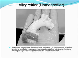  Aortic valve allograft after harvesting from the donor. The block includes a variable
amount of ventricular muscle and the anterior leaflet of the mitral valve. Additional
trimming for replacement is performed at the time of implantation.
Allogreftler (Homogreftler)
 
