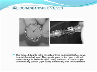  The Cribier-Edwards valve consists of three pericardial leaflets sewn
to a stainless-steel stent. The valve is stored in the open position to
avoid damage to the leaflets (left panel) and must be hand-crimped
to the delivery balloon (right panel) immediately prior to implantation.
BALLOON-EXPANDABLE VALVES
 