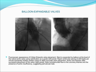  Fluoroscopic appearance of Cribier-Edwards valve placement. Stent is expanded by balloon at the level of
the native aortic valve using calcification as a guide (left panel). Rapid ventricular pacing at 220 beats per
minute transiently inhibits cardiac output to allow accurate valve placement. Aortic root injection after
successful placement of the valve (right panel). Note nonobstructed flow to the coronary arteries and the
presence of aortic insufficiency, suggesting perivalvular leak.
BALLOON-EXPANDABLE VALVES
 