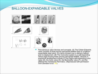  Percutaneous valve devices and concepts. (A) The Cribier-Edwards
valve consists of three equine pericardial leaflets fixed to a balloon-
expandable steel stent. It is hand-crimped over a delivery balloon
prior to deployment. (B) The Corevalve system is a self-expanding
nitinol cage housing three porcine pericardial leaflets. Devices in
preclinical development include (C) the Sadra self-expanding Lotus
valve (D), the Aortx valve (E), the Bonhoeffer valve (F), and the
eNitinol thin membrane PercValve. (Reproduced with permission
from Davidson et al.180)
BALLOON-EXPANDABLE VALVES
 