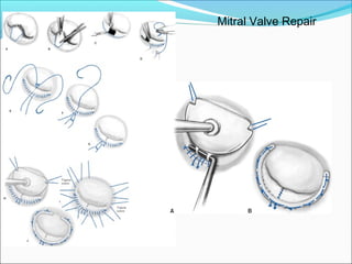 Mitral Valve Repair
 