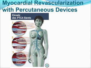 Myocardial Revascularization
with Percutaneous Devices
 
