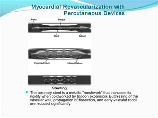  The coronary stent is a metallic "meshwork" that increases its
rigidity when coldworked by balloon expansion. Buttressing of the
vascular wall, propagation of dissection, and early vascular recoil
are reduced significantly.
Myocardial Revascularization with
Percutaneous Devices
 