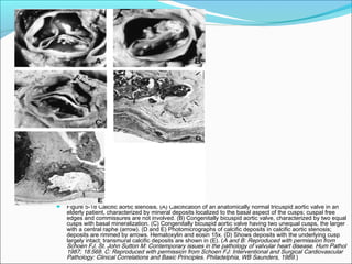  Figure 5-18 Calcific aortic stenosis. (A) Calcification of an anatomically normal tricuspid aortic valve in an
elderly patient, characterized by mineral deposits localized to the basal aspect of the cusps; cuspal free
edges and commissures are not involved. (B) Congenitally bicuspid aortic valve, characterized by two equal
cusps with basal mineralization. (C) Congenitally bicuspid aortic valve having two unequal cusps, the larger
with a central raphe (arrow). (D and E) Photomicrographs of calcific deposits in calcific aortic stenosis;
deposits are rimmed by arrows. Hematoxylin and eosin 15x. (D) Shows deposits with the underlying cusp
largely intact; transmural calcific deposits are shown in (E). (A and B: Reproduced with permission from
Schoen FJ, St. John Sutton M: Contemporary issues in the pathology of valvular heart disease. Hum Pathol
1987; 18:568. C: Reproduced with permission from Schoen FJ: Interventional and Surgical Cardiovascular
Pathology: Clinical Correlations and Basic Principles. Philadelphia, WB Saunders, 1989.)
 