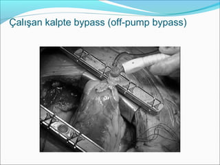 Çalışan kalpte bypass (off-pump bypass)
 