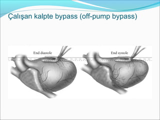 Çalışan kalpte bypass (off-pump bypass)
 