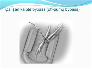Çalışan kalpte bypass (off-pump bypass)
 