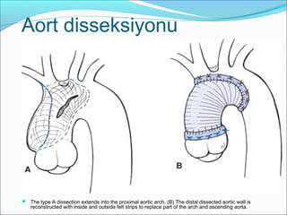 Aort disseksiyonu
 The type A dissection extends into the proximal aortic arch. (B) The distal dissected aortic wall is
reconstructed with inside and outside felt strips to replace part of the arch and ascending aorta.
 