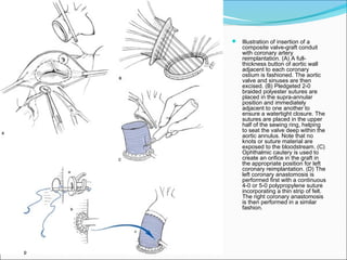  Illustration of insertion of a
composite valve-graft conduit
with coronary artery
reimplantation. (A) A full-
thickness button of aortic wall
adjacent to each coronary
ostium is fashioned. The aortic
valve and sinuses are then
excised. (B) Pledgeted 2-0
braided polyester sutures are
placed in the supra-annular
position and immediately
adjacent to one another to
ensure a watertight closure. The
sutures are placed in the upper
half of the sewing ring, helping
to seat the valve deep within the
aortic annulus. Note that no
knots or suture material are
exposed to the bloodstream. (C)
Ophthalmic cautery is used to
create an orifice in the graft in
the appropriate position for left
coronary reimplantation. (D) The
left coronary anastomosis is
performed first with a continuous
4-0 or 5-0 polypropylene suture
incorporating a thin strip of felt.
The right coronary anastomosis
is then performed in a similar
fashion.
 
