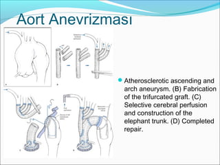 Aort Anevrizması
Atherosclerotic ascending and
arch aneurysm. (B) Fabrication
of the trifurcated graft. (C)
Selective cerebral perfusion
and construction of the
elephant trunk. (D) Completed
repair.
 