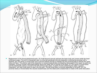  Replacement of the thoracoabdominal aorta. (A) A left femoral cannula perfuses the lower body and viscera while the heart
continues to eject. The arch is transected near or at the left subclavian and any dissection involving the proximal cuff is
repaired. (B) The clamp is moved down and a second arterial cannula is inserted into the proximal graft to perfuse the upper
body and heart. The anterior wall of the dissection is incised longitudinally and bleeding intercostals of the upper six pairs are
oversewn. A group of lower intercostal arteries above the celiac axis is sutured to the graft. (C) The clamp is moved down
and the distal aortic clamp is moved to the left common iliac artery. A patch of aorta containing the celiac, superior
mesenteric, and right renal artery is sewn into the graft. The left renal artery is sutured separately to the graft. (D) The
proximal clamp is moved below the visceral anastomoses and the distal aortic anastomosis is made to the aortic bifurcation.
 