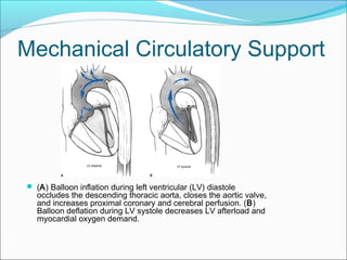 Mechanical Circulatory Support
 (A) Balloon inflation during left ventricular (LV) diastole
occludes the descending thoracic aorta, closes the aortic valve,
and increases proximal coronary and cerebral perfusion. (B)
Balloon deflation during LV systole decreases LV afterload and
myocardial oxygen demand.
 