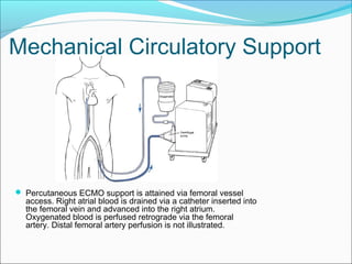 Mechanical Circulatory Support
 Percutaneous ECMO support is attained via femoral vessel
access. Right atrial blood is drained via a catheter inserted into
the femoral vein and advanced into the right atrium.
Oxygenated blood is perfused retrograde via the femoral
artery. Distal femoral artery perfusion is not illustrated.
 