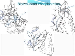 Bicaval heart transplantation
 