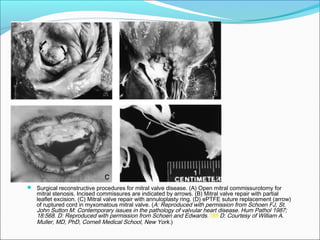  Surgical reconstructive procedures for mitral valve disease. (A) Open mitral commissurotomy for
mitral stenosis. Incised commissures are indicated by arrows. (B) Mitral valve repair with partial
leaflet excision. (C) Mitral valve repair with annuloplasty ring. (D) ePTFE suture replacement (arrow)
of ruptured cord in myxomatous mitral valve. (A: Reproduced with permission from Schoen FJ, St.
John Sutton M: Contemporary issues in the pathology of valvular heart disease. Hum Pathol 1987;
18:568. D: Reproduced with permission from Schoen and Edwards.185 D: Courtesy of William A.
Muller, MD, PhD, Cornell Medical School, New York.)
 