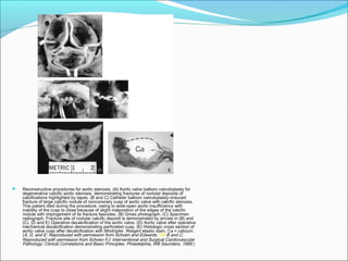  Reconstructive procedures for aortic stenosis. (A) Aortic valve balloon valvuloplasty for
degenerative calcific aortic stenosis, demonstrating fractures of nodular deposits of
calcifications highlighted by tapes. (B and C) Catheter balloon valvuloplasty–induced
fracture of large calcific nodule of noncoronary cusp of aortic valve with calcific stenosis.
This patient died during the procedure, owing to wide-open aortic insufficiency with
inability of the cusp to close because of slight malposition of the edges of the calcific
nodule with impingement of its fracture fascicles. (B) Gross photograph; (C) Specimen
radiograph. Fracture site of nodular calcific deposit is demonstrated by arrows in (B) and
(C). (D and E) Operative decalcification of the aortic valve. (D) Aortic valve after operative
mechanical decalcification demonstrating perforated cusp. (E) Histologic cross section of
aortic valve cusp after decalcification with lithotripter. Weigert elastic stain. Ca = calcium.
(A, D, and E: Reproduced with permission from Schoen and Edwards.185 B and C:
Reproduced with permission from Schoen FJ: Interventional and Surgical Cardiovascular
Pathology: Clinical Correlations and Basic Principles. Philadelphia, WB Saunders, 1989.)
 