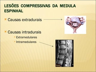 Causas extradurais Causas intradurais Extramedulares Intramedulares 