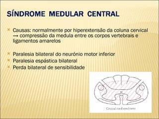 Causas: normalmente por hiperextensão da coluna cervical -> compressão da medula entre os corpos vertebrais e ligamentos amarelos Paralesia bilateral do neurónio motor inferior Paralesia espástica bilateral Perda bilateral de sensibilidade 