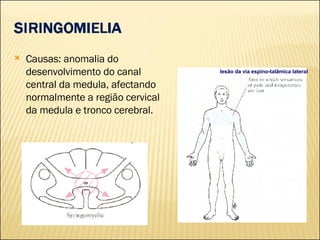 Causas: anomalia do desenvolvimento do canal central da medula, afectando normalmente a região cervical da medula e tronco cerebral. lesão da via espino-talâmica lateral 