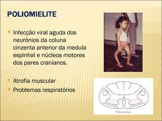Infecção viral aguda dos neurónios da coluna cinzenta anterior da medula espinhal e núcleos motores dos pares cranianos. Atrofia muscular Problemas respiratórios 