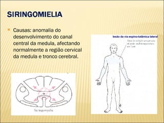 <ul><li>Causas: anomalia do desenvolvimento do canal central da medula, afectando normalmente a região cervical da medula ...