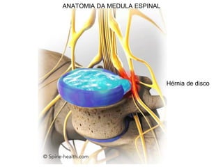 ANATOMIA DA MEDULA ESPINAL
Hérnia de disco
 