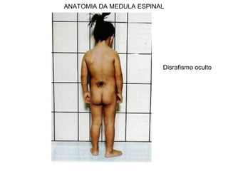 ANATOMIA DA MEDULA ESPINAL
Disrafismo oculto
 