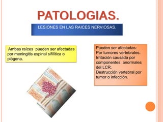 LESIONES EN LAS RAICES NERVIOSAS.
Ambas raíces pueden ser afectadas
por meningitis espinal sifilítica o
piógena.
Pueden ser afectadas:
Por tumores vertebrales.
Irritación causada por
componentes anormales
del LCR.
Destrucción vertebral por
tumor o infección.
 