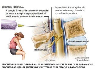 BLOQUEO PERIDURAL O EPIDURAL.- EL ANESTESICO SE INYECTA ARRIBA DE LA DURA MADRE,
BLOQUEO RAQUIAL.- EL ANESTESICO SE INYECTABA EN EL ESPACIO SUBARACNOIDEO
 