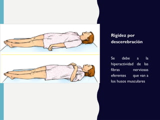Rigidez por
descerebración
Se debe a la
hiperactividad de las
fibras nerviosas
eferentes que van a
los husos musculares
 