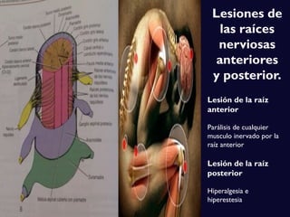 Lesión de la raíz
anterior
Parálisis de cualquier
musculo inervado por la
raíz anterior
Lesión de la raíz
posterior
Hiperalgesia e
hiperestesia
Lesiones de
las raíces
nerviosas
anteriores
y posterior.
 