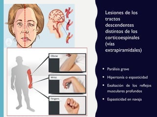 • Parálisis grave
• Hipertonía o espasticidad
• Exaltación de los reflejos
musculares profundos
• Espasticidad en navaja
Lesiones de los
tractos
descendentes
distintos de los
corticoespinales
(vías
extrapiramidales)
 