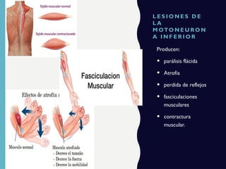 L E S I O N E S D E
L A
M OTO N E U R O N
A I N F E R I O R
Producen:
• parálisis flácida
• Atrofia
• perdida de reflejos
• fasciculaciones
musculares
• contractura
muscular.
 