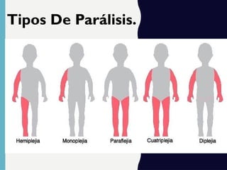 Tipos De Parálisis.
 
