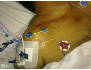 Desmistificando a Doação e o Transplante de Medula Óssea