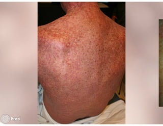 Desmistificando a Doação e o Transplante de Medula Óssea