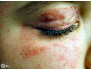 Desmistificando a Doação e o Transplante de Medula Óssea