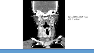 Coronal CT Neck Soft Tissue
with IV contrast
 