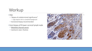 Workup
• FNA
• “Atypia of undetermined significance”
• Large atypical cells in a lymphoid background
• Excisional biopsy recommended
• Core biopsy of R lower cervical lymph node
• Medullary thyroid cancer
• Calcitonin stain: Positive
1
 