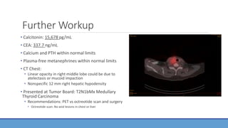 Further Workup
• Calcitonin: 15,678 pg/mL
• CEA: 337.7 ng/mL
• Calcium and PTH within normal limits
• Plasma-free metanephrines within normal limits
• CT Chest:
• Linear opacity in right middle lobe could be due to
atelectasis or mucoid impaction
• Nonspecific 12 mm right hepatic hypodensity
• Presented at Tumor Board: T2N1bMx Medullary
Thyroid Carcinoma
• Recommendations: PET vs octreotide scan and surgery
• Octreotide scan: No avid lesions in chest or liver
 