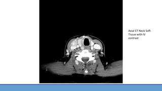 Axial CT Neck Soft
Tissue with IV
contrast
 